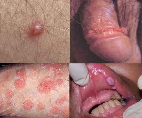 condilom imens papillomavirus in mouth symptoms