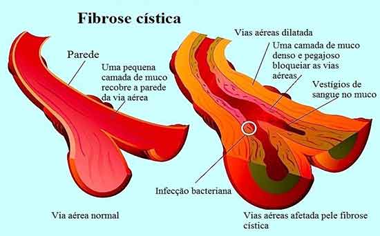 sintomas-da-fibrose-cistica