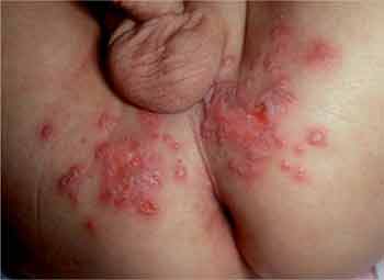 Herpes simplex vírus 1 (HSV-1)