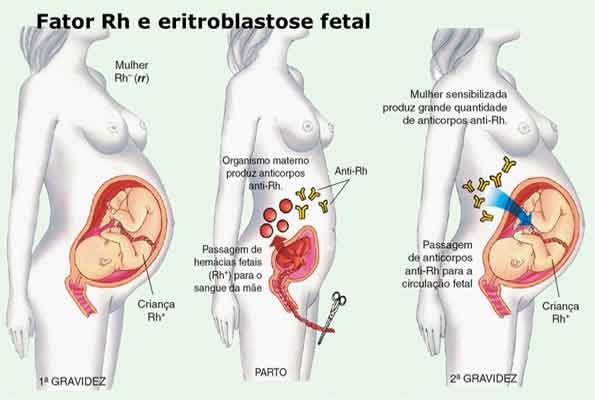Eritroblastose Fetal – doença hemolítica do recém-nascido – o que é