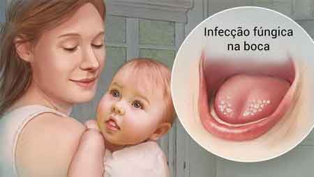 infecção fúngica na boca por cândida