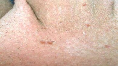 O Condiloma Acuminado pode causar verrugas nas regiões anal ou genital. Veja os sintomas, prevenção, diagnóstico e tratamento dessa doença
