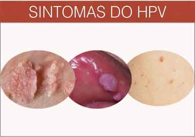 Condiloamele și modul în care sunt transmise Papillomavirus saignement