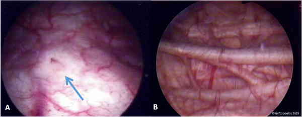 Fig 3 - Vista endoscópica da bexiga. (A) Trígono e orifício ureteral direito. (B) Trabéculas proeminentes da parede da bexiga (fibras hipertróficas do músculo detrusor).