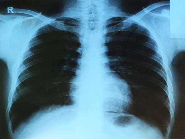 Como os pulmões funcionam, estruturas, qual a sua importância e suas funções