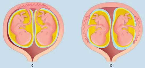 Os gêmeos podem não compartilhar nenhum dos anexos embrionários