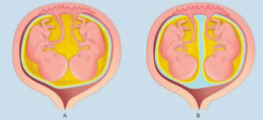 Os gêmeos podem compartilhar todos os anexos embrionários ou compartilhar apenas a placenta 