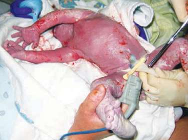 Logo após o parto, o cordão umbilical é cortado 